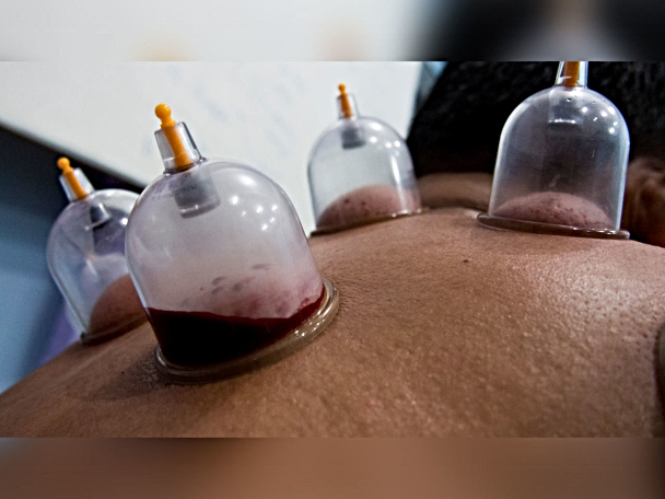 Wet Cupping